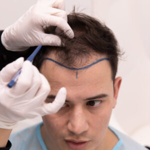 Affordable Excellence: Navigating Hair Transplant Cost in the UK