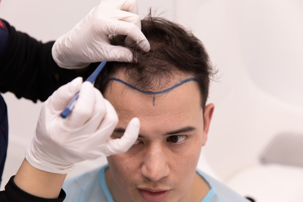 Affordable Excellence: Navigating Hair Transplant Cost in the UK